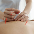 Acupuncture for Fibromyalgia: A Natural Treatment Option for Pain Relief