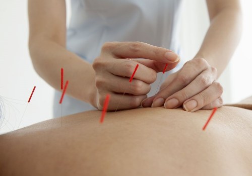 Acupuncture for Fibromyalgia: A Natural Treatment Option for Pain Relief
